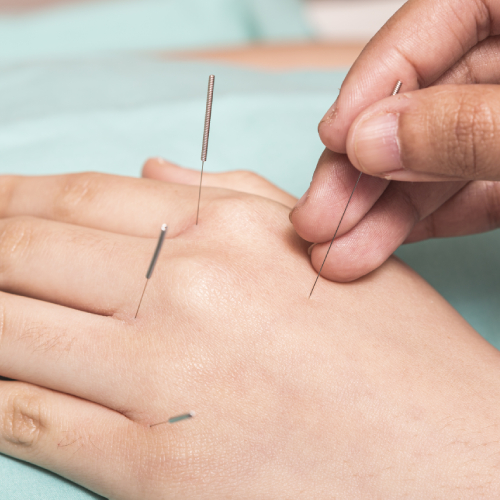Dry Needling Treatment