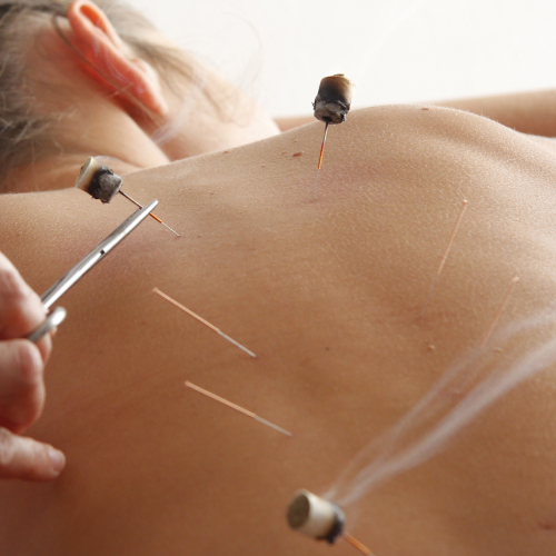 Needling Therapy in Action